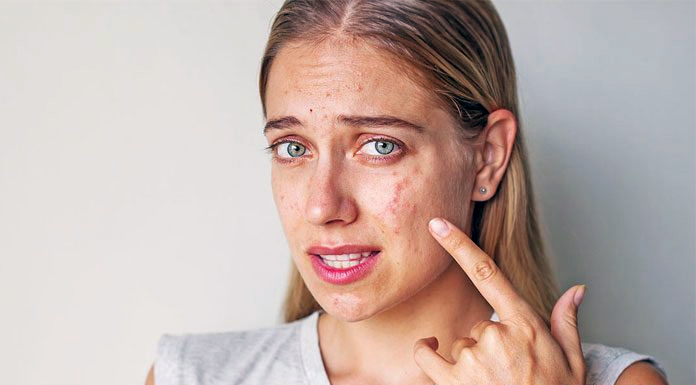 adult acne