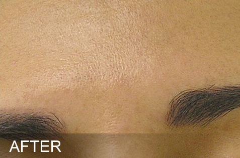 HydraFacial – Brown Spots – After HydraFacial - Brown Spots - After