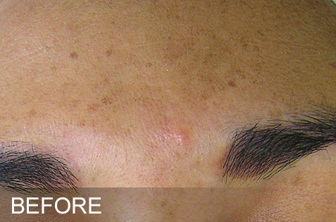 HydraFacial – Brown Spots – Before HydraFacial - Brown Spots - Before