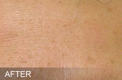 HydraFacial – Fine Lines – After HydraFacial - Fine Lines - After