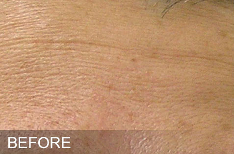 HydraFacial – Fine Lines – Before HydraFacial - Fine Lines - Before
