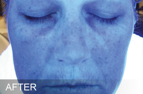 HydraFacial – Hydration – After HydraFacial - Hydration - After
