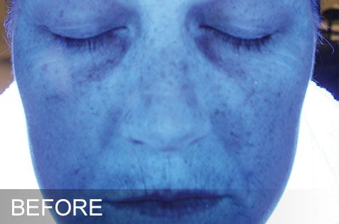 HydraFacial – Hydration – Before HydraFacial - Hydration - Before