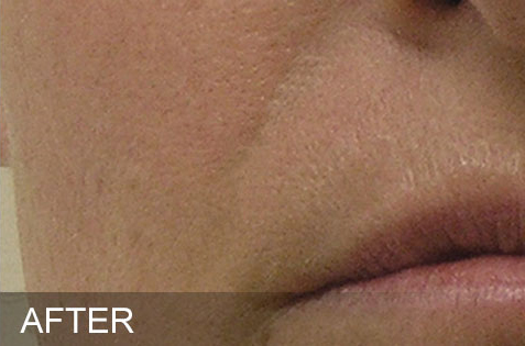 HydraFacial – Nasolabial Folds – After HydraFacial - Nasolabial Folds - After