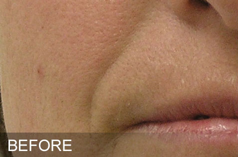 HydraFacial – Nasolabial Folds – Before HydraFacial - Nasolabial Folds - Before