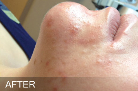 HydraFacial – Oily Congested – After HydraFacial - Oily Congested - After