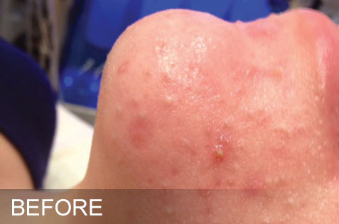 HydraFacial – Oily Congested – Before HydraFacial - Oily Congested - Before