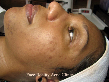 Hyperpigmentation Before