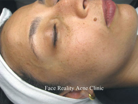 Hyperpigmentation After