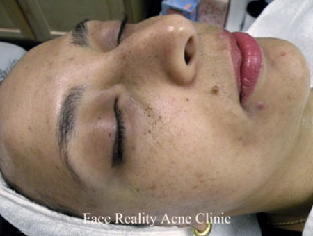 Hyperpigmentation Before