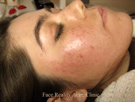 Acne Consultation Palm Beach Gardens