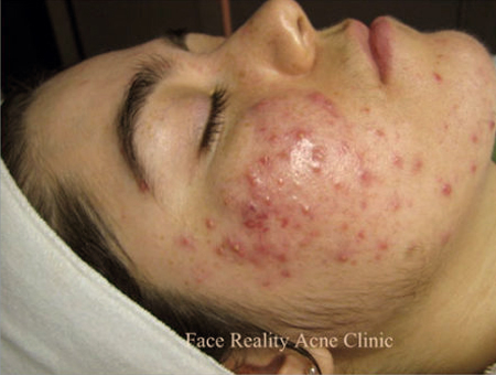 Treating Inflamed Acne Before