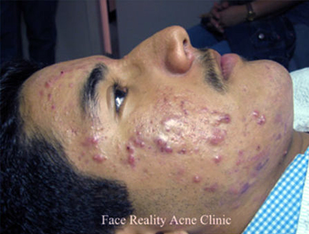 Inflamed Acne Before