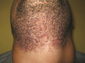 Laser Hair Removal - Men - Neck - Before