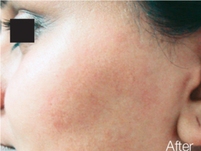 Laser Hair Removal - Women - Face - After