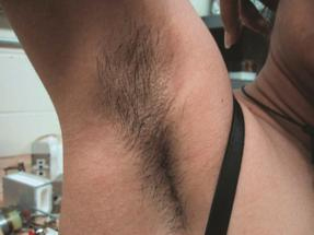 Laser Hair Removal - Underarm - Before