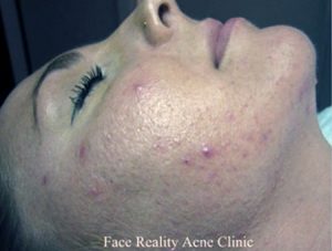 Noninflamed Acne Before