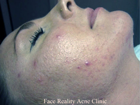 Treating Noninflamed Acne Before