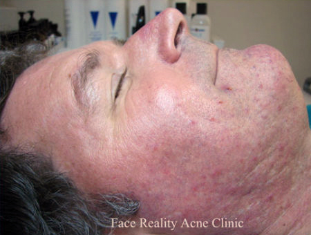 Rosacea Before