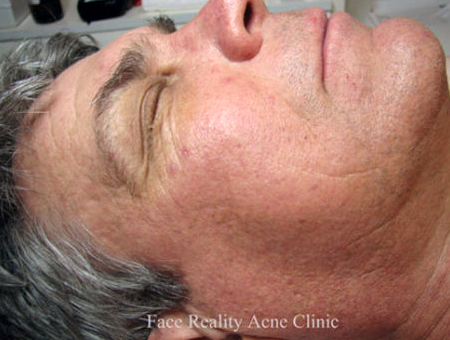 Rosacea After Rosacea After