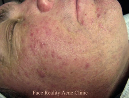 Acne Rosacea Before and After