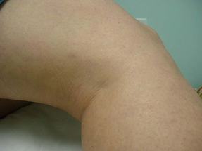 Spider Vein Removal - After