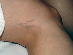 Spider Vein Removal - Before