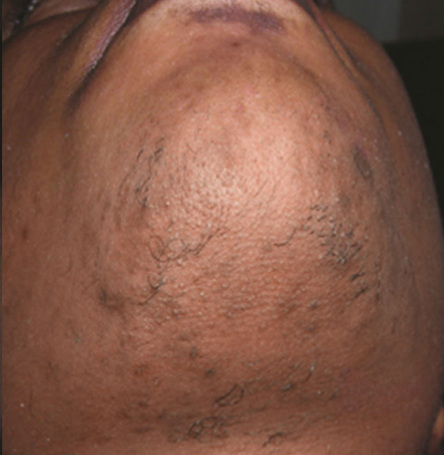 Hair Removal chin - After