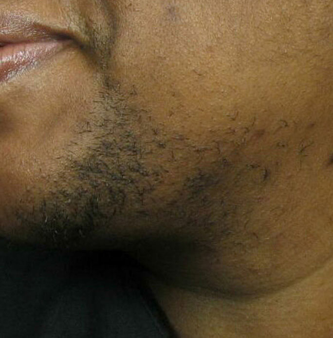 Hair Removal Dark Skin - Before