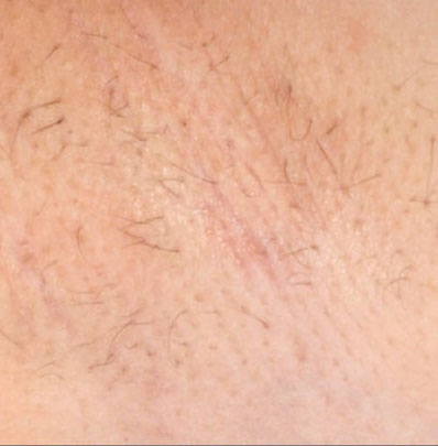 Hair Removal Underarm - After