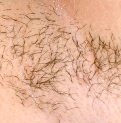 Hair Removal Underarm - Before