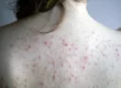 Back Acne Treatment Palm Beach Gardens