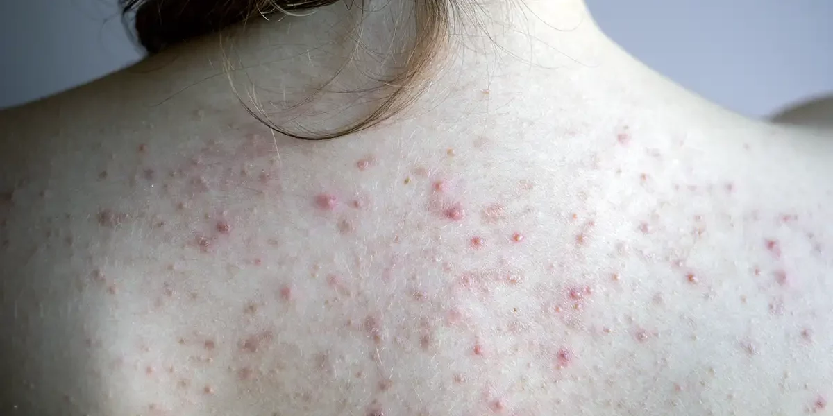 Back Acne Treatment Palm Beach Gardens