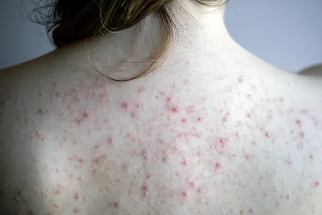 Back Acne Treatment Palm Beach Gardens