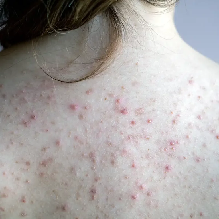 Back Acne Treatment Palm Beach Gardens