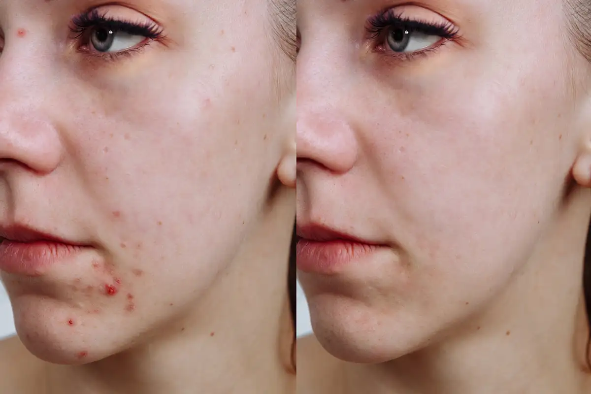 Treatments for Teen Acne near me