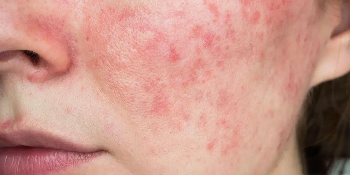 Acne Rosacea Treatment in Palm Beach Gardens