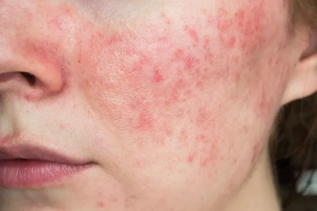 Acne Rosacea Treatment in Palm Beach Gardens