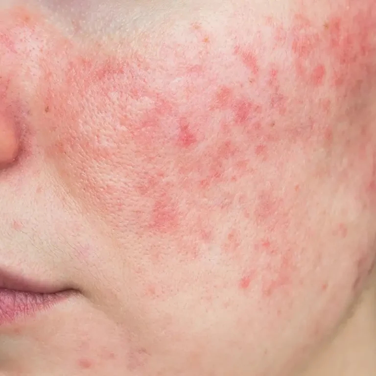 Acne Rosacea Treatment in Palm Beach Gardens