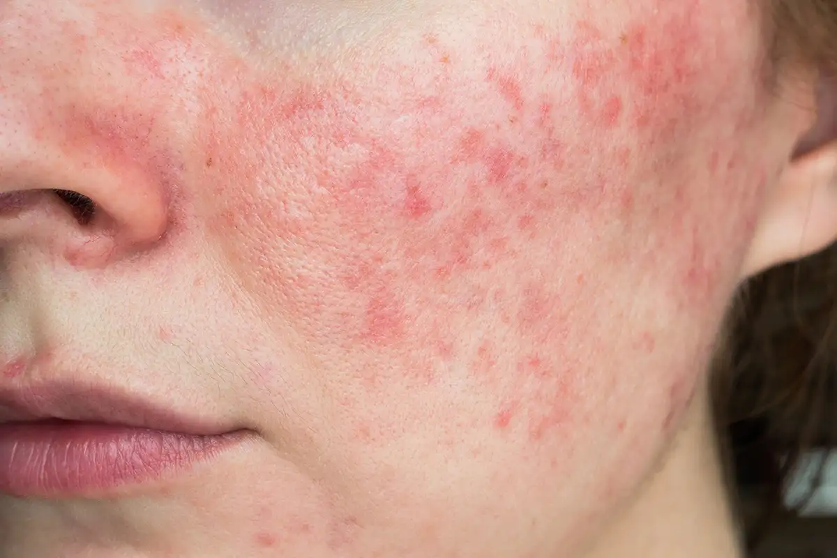 Acne Rosacea Treatment in Palm Beach Gardens