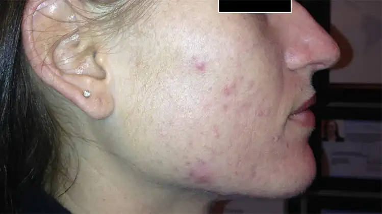 Celluma LED Light Therapy Treatment for Acne - After Photo