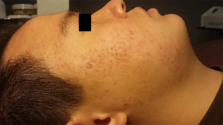 LED Light Acne Therapy After