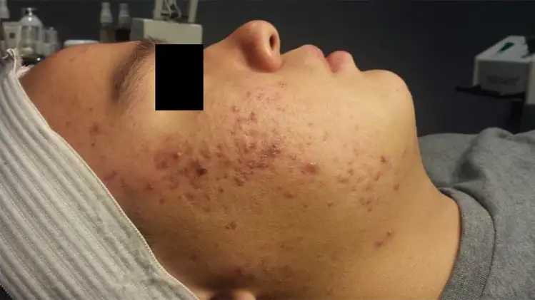 LED Light Acne Therapy Before