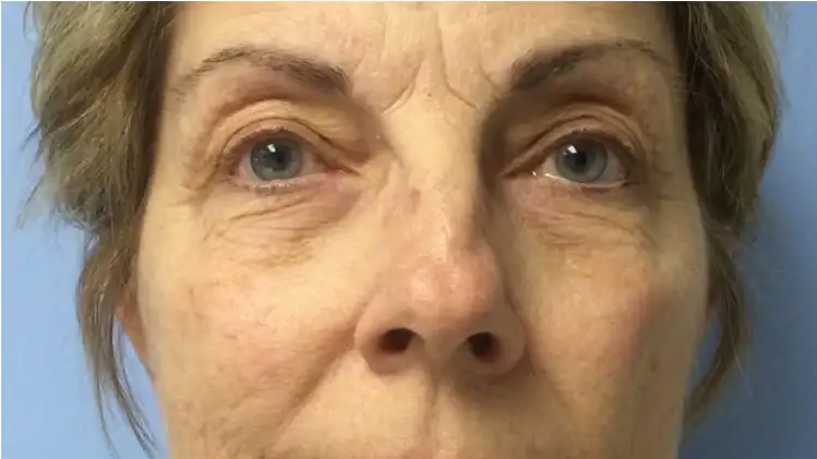 LED Light Therapy Before / Anti-Aging Results