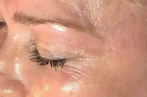 Hydrafacial after Hydrafacial after