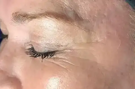 Hydrafacial before