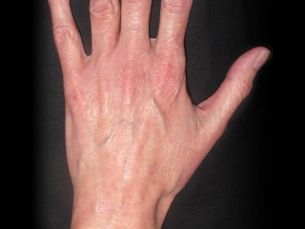 Hands Age Spot Removal After