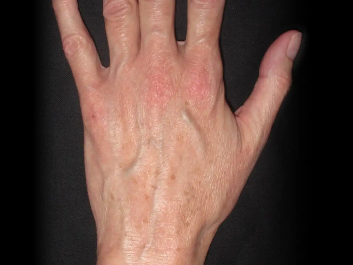 Hands Age Spot Removal Before