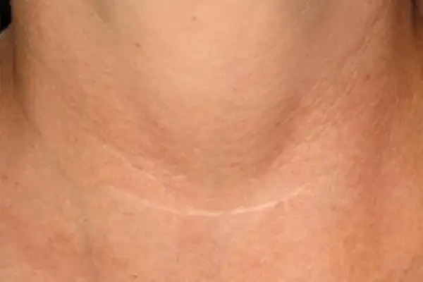 Laser Genesis Scar Treatment After (3 Treatments)