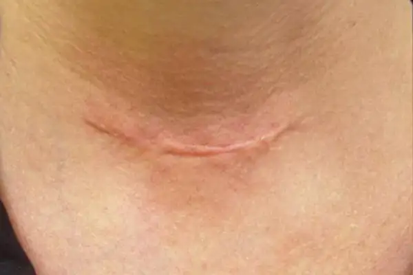 Laser Genesis Scar Treatment Before